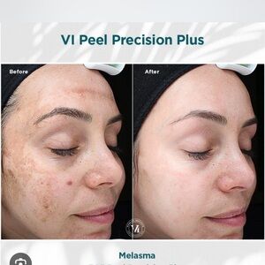 VI Peel Precision Plus Skincare Treatment